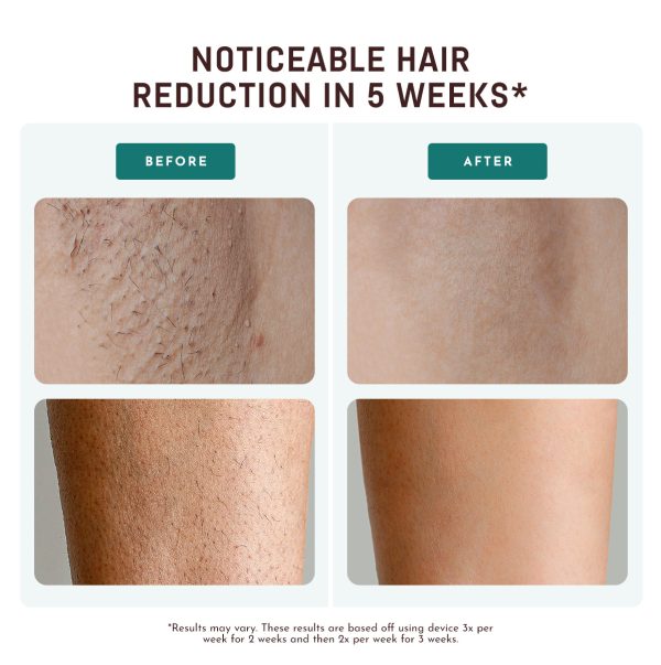 GlacierPro Laser Hair Removal - Image 2